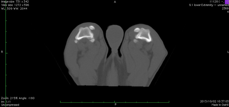 CT スキャンにより骨の形状を把握