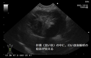 胆嚢粘液嚢腫